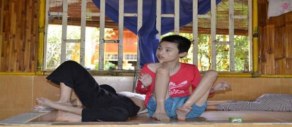 bại não - khuyết tật - Hình mô tả 11