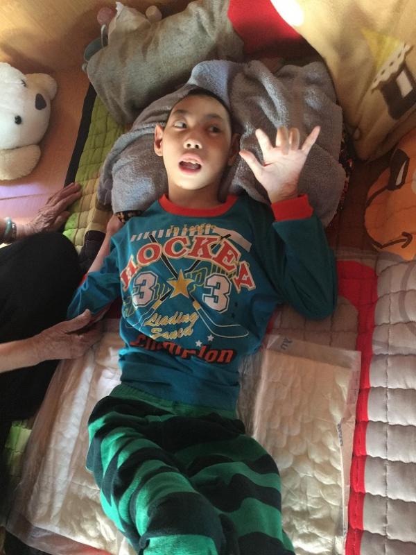 bại não - khuyết tật - Hình mô tả 12