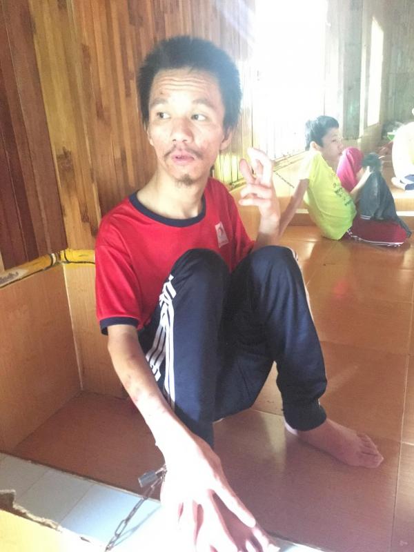 bại não - khuyết tật - Hình mô tả 17