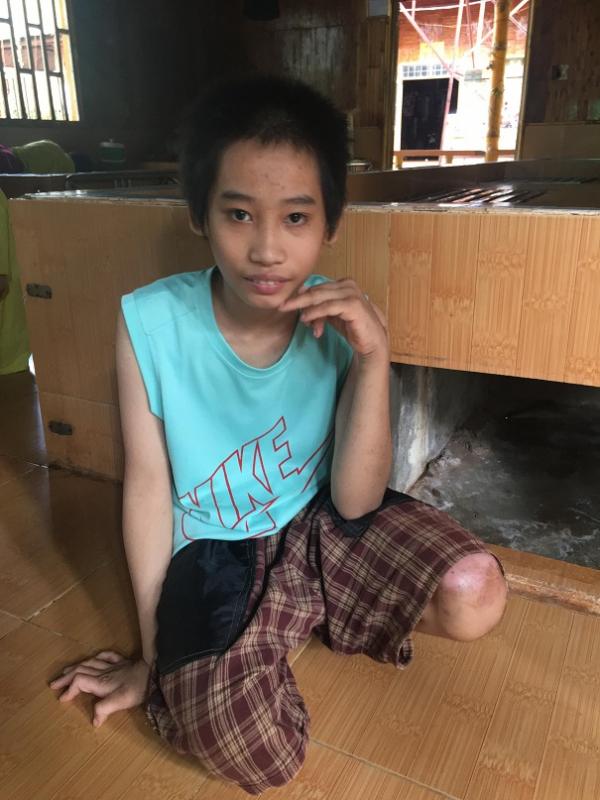 bại não - khuyết tật - Hình mô tả 18